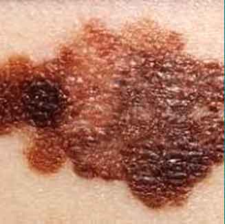 Melanoma skin disease