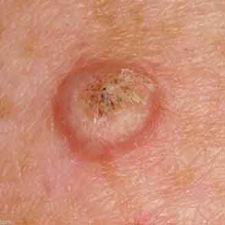 photo of a skin disease detected by Bega Valley Skin Cancer clinic